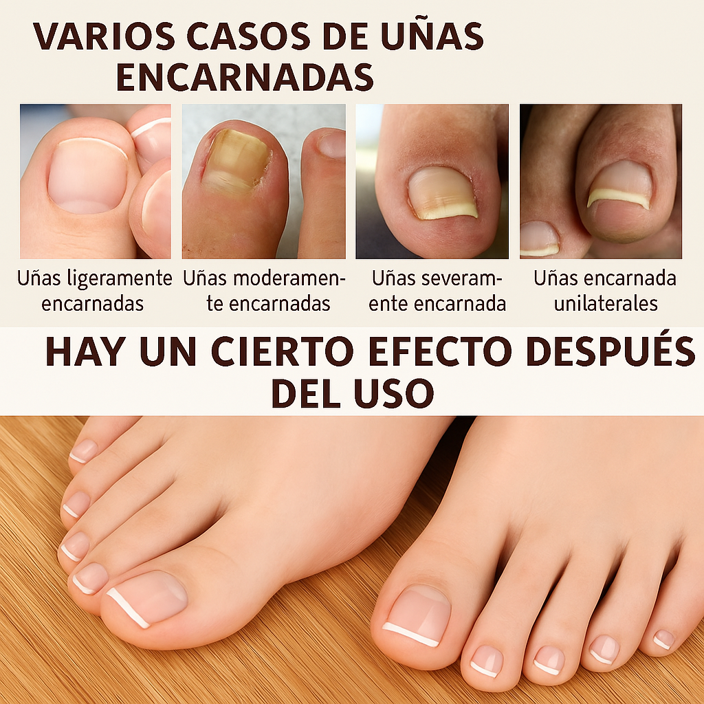 🟩 Anti Hongos Profesional  – German ToenailPlus
